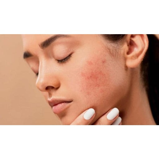 Acne on Dry Skin