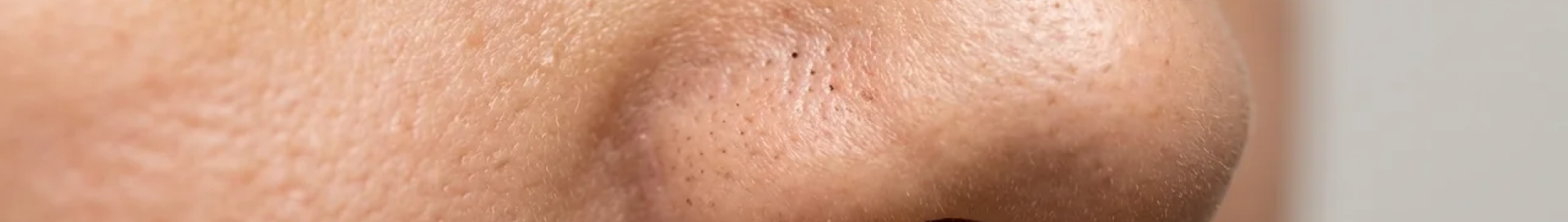 BLACKHEADS