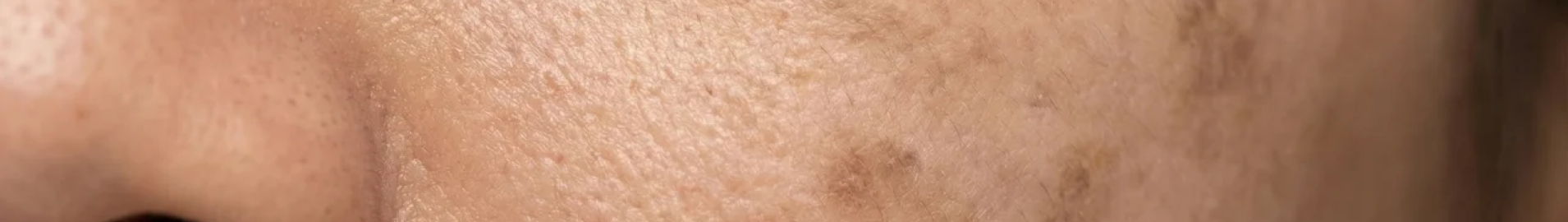 HYPERPIGMENTATION