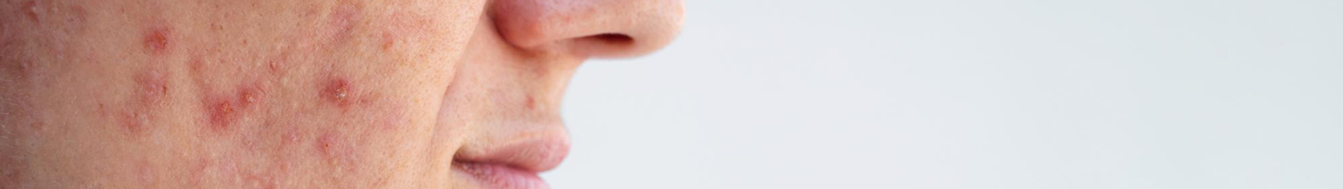 ACNE & BREAKOUTS